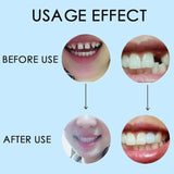 10g/100g Denture Solid Glue Dental Restoration Temporary Tooth Repair Kit Oral Care Tool
